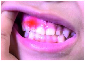 Gumteeth