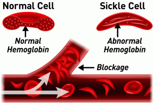 Sickle-Cell