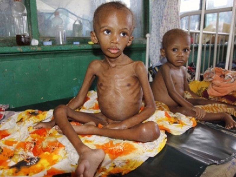 Malnourished-children