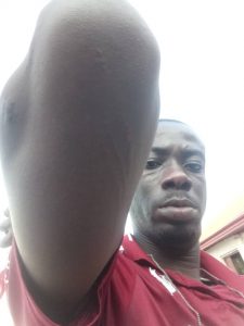The Nation newspaper correspondent in Ebonyi State, Mr Ogochukwu Anioke, showing the injuries on his arm and lower lip after the attack on some journalists by a lawmaker and a commissioner nominee (1)