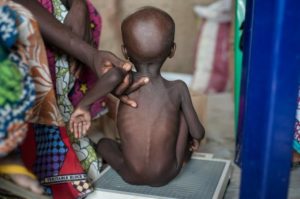 malnutrition