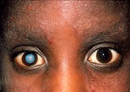 Cataract,