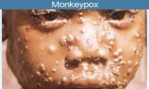 Fear grips Nigerians as monkey pox epidemic returns