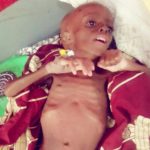UNICEF raises alarm over malnutrition in Nasarawa
