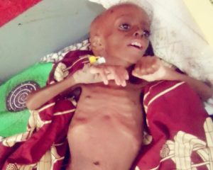 UNICEF raises alarm over malnutrition in Nasarawa