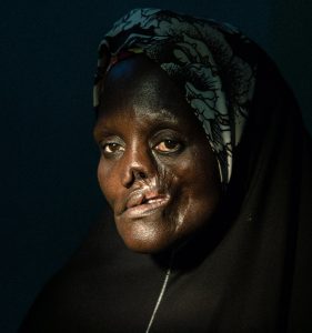 Noma disease silently killing Nigerians