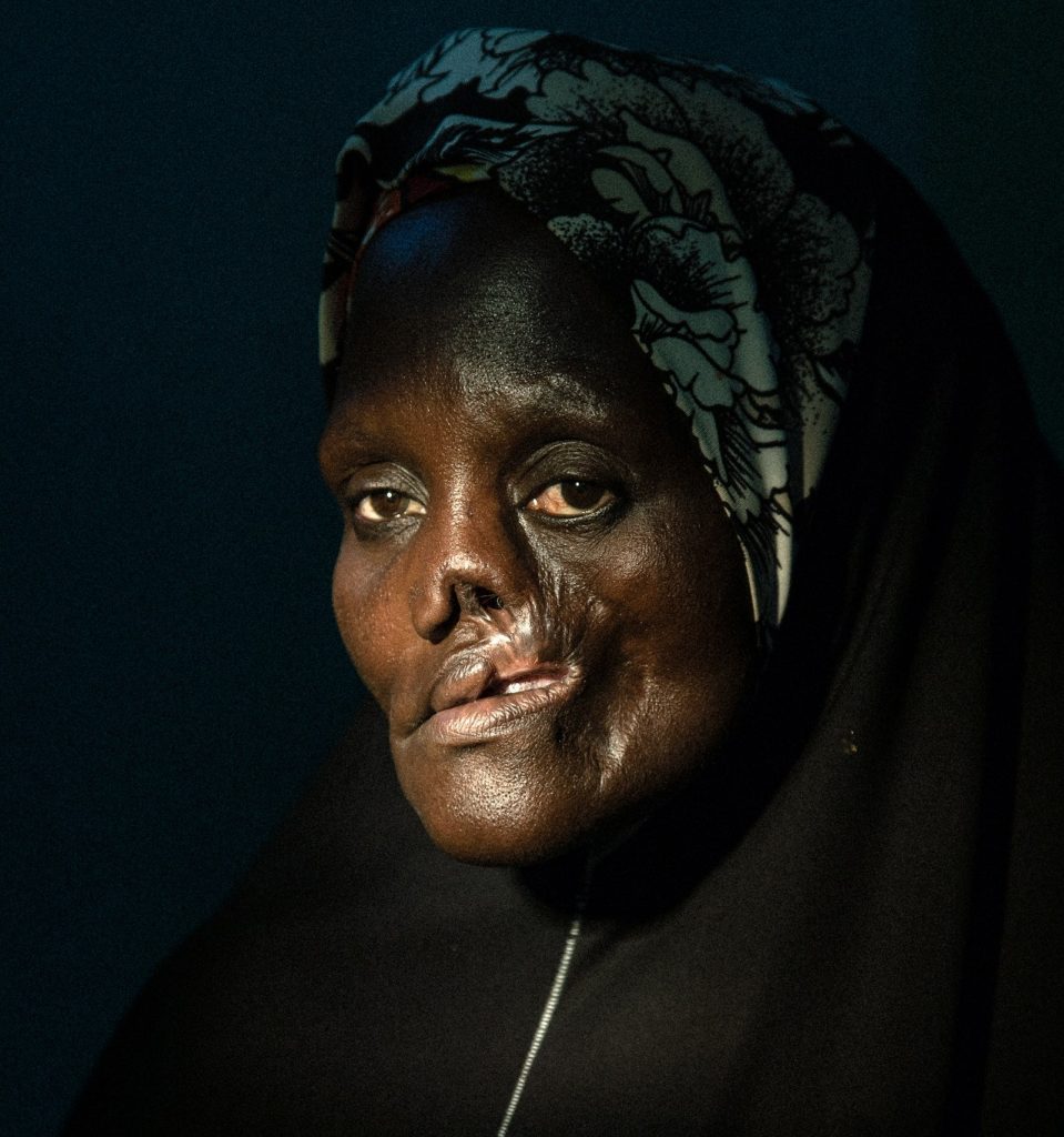Noma disease silently killing Nigerians
