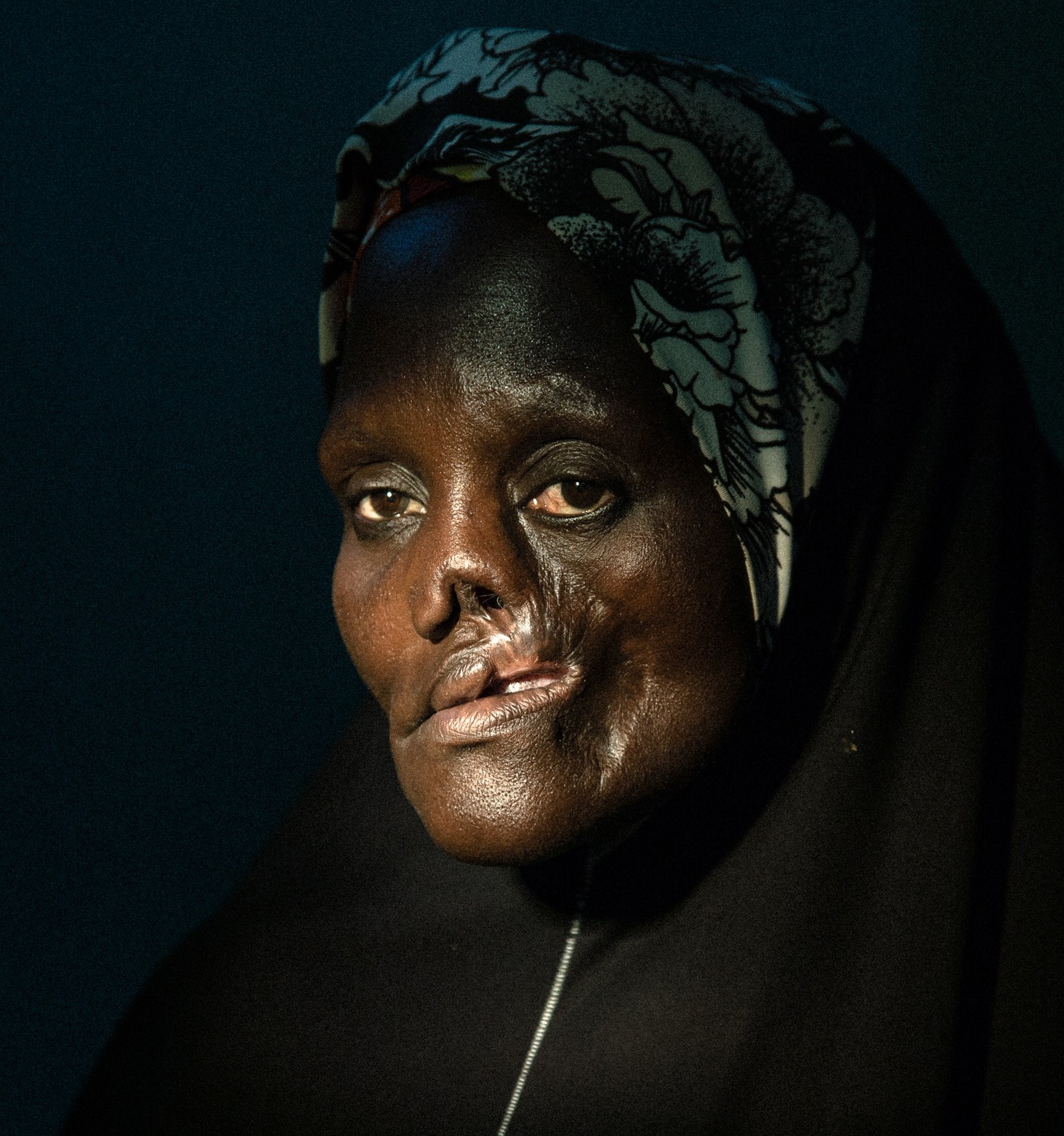 Noma disease silently killing Nigerians