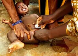 Female genital mutilation