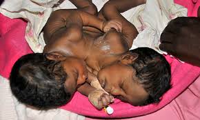conjoined twins delivered at Hayin Kadage