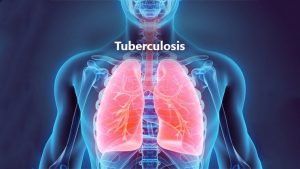 Tuberculosis