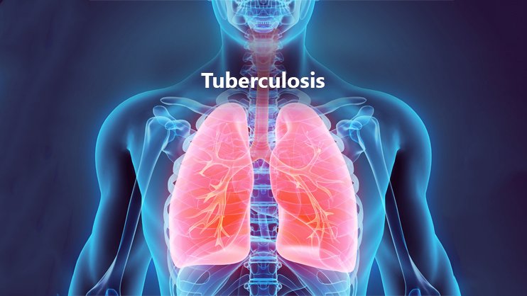 Tuberculosis