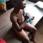 Nneoma with bruises all over her body