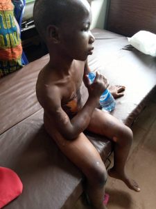 Nneoma with bruises all over her body