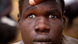50 million Nigerians at risk of river blindness – programme manager