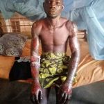 Love gone awry: Girlfriend sets estranged lover on fire