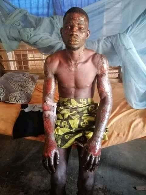 Love gone awry: Girlfriend sets estranged lover on fire