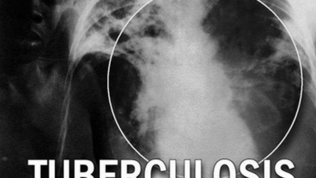tuberculosis-front-pic