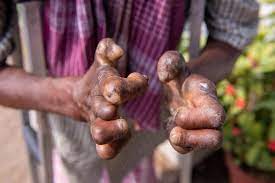 Leprosy