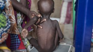 malnutrition