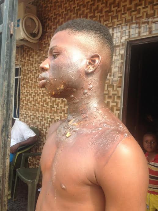 Kerosene explosion burns 16-year-old in Nsukka