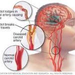 stroke