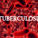 Tuberculosis