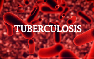 Tuberculosis