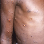 Monkeypox: NCDC yet to release health guidelines for airlines, airports