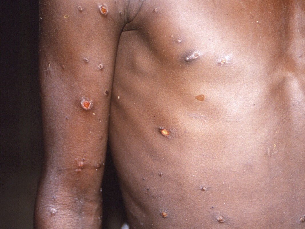 Monkeypox: NCDC yet to release health guidelines for airlines, airports