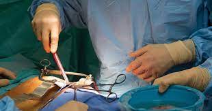 Cameroon successfully conducts 3 kidney transplant operations