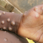 MONKEYPOX