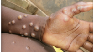 MONKEYPOX