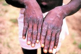 Monkeypox