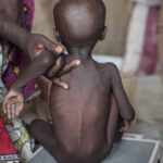 acute-malnutrition-in-children