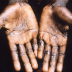 monkeypox