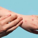 monkeypox-symptoms-signs-rash-4112433
