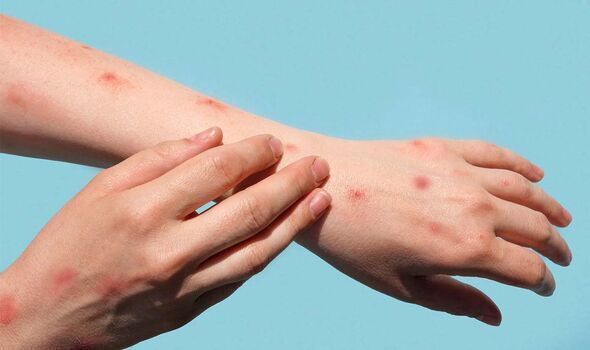 monkeypox-symptoms-signs-rash-4112433