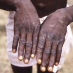 FILE – This 1997 image provided by the CDC during an investigation into an outbreak of monkeypox, which took place in the Democratic Republic of the Congo (DRC), formerly Zaire, and depicts the dorsal surfaces of the hands of a monkeypox case patient, who was displaying the appearance of the characteristic rash during its recuperative stage. The World Health Organization is convening its emergency committee on Thursday, July 21, 2022 to consider for the second time within weeks whether the expanding outbreak of monkeypox should be declared a global crisis. (CDC via AP, File)