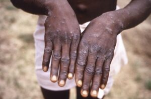 FILE – This 1997 image provided by the CDC during an investigation into an outbreak of monkeypox, which took place in the Democratic Republic of the Congo (DRC), formerly Zaire, and depicts the dorsal surfaces of the hands of a monkeypox case patient, who was displaying the appearance of the characteristic rash during its recuperative stage. The World Health Organization is convening its emergency committee on Thursday, July 21, 2022 to consider for the second time within weeks whether the expanding outbreak of monkeypox should be declared a global crisis. (CDC via AP, File)