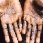 Monkeypox-1-780×470