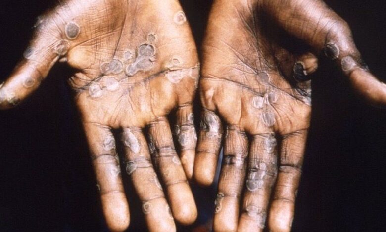 Monkeypox-1-780×470