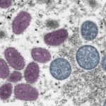 Monkeypox: First deaths outside Africa in Brazil and Spain