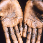 Four suspected cases of Monkeypox reported in Borno – Official