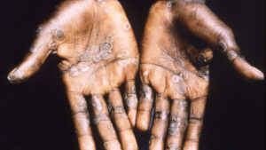 Four suspected cases of Monkeypox reported in Borno – Official