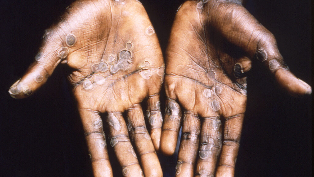 Four suspected cases of Monkeypox reported in Borno – Official