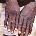 Monkeypox: Nasarawa records 6 cases as health ministry cautions residents on environmental hygiene