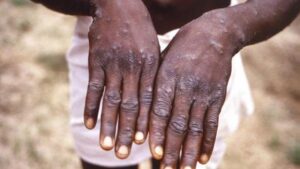 Monkeypox: Nasarawa records 6 cases as health ministry cautions residents on environmental hygiene