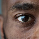 Nearly 7 million people are blind in Nigeria, eye doctors say