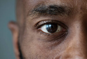 Nearly 7 million people are blind in Nigeria, eye doctors say